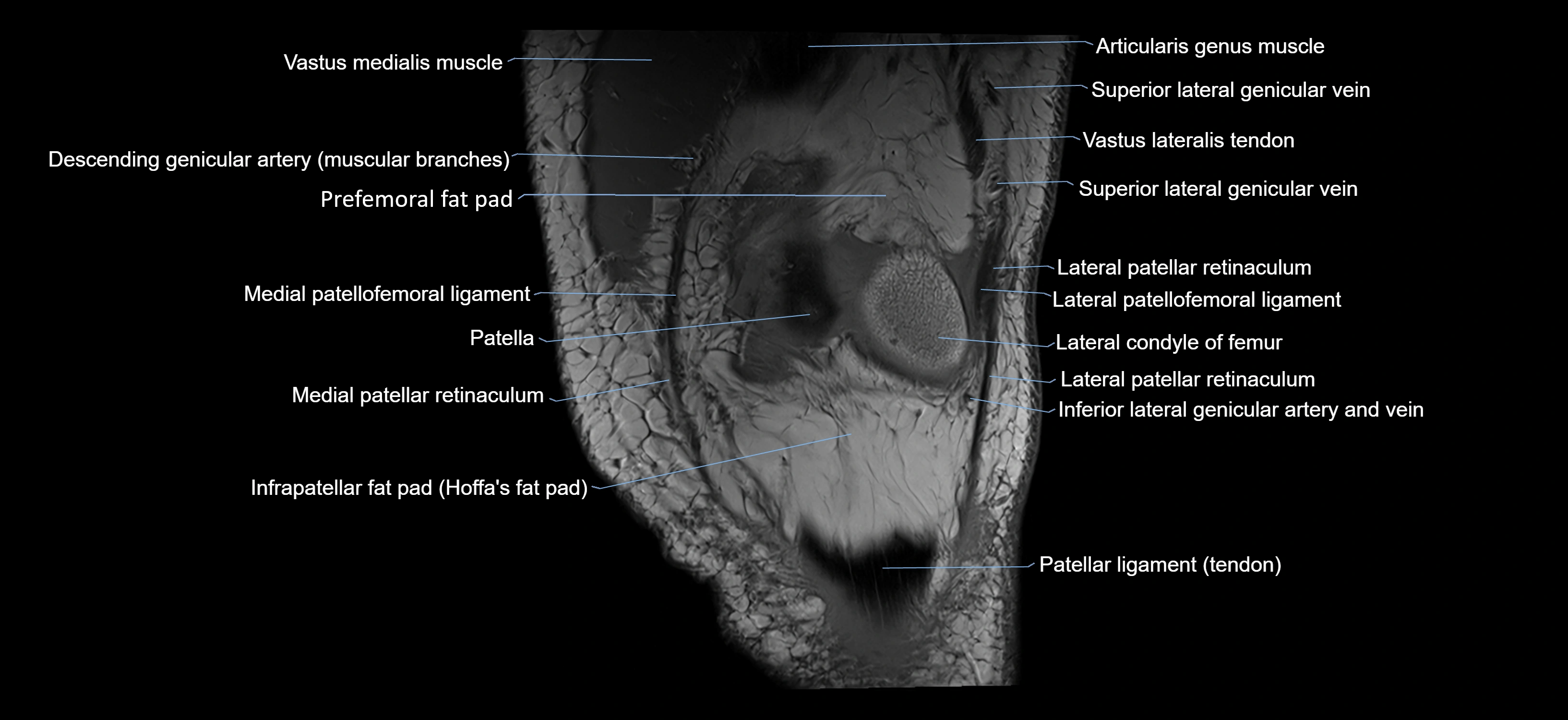 MRI knee coronal cross sectional anatomy labelled 3T radiology  image-04001-00009.webp